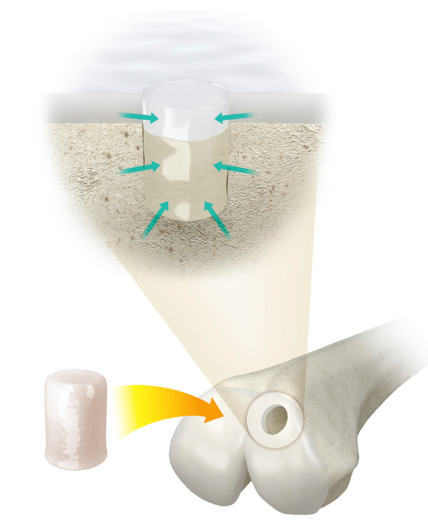 Osteochondral Regeneration