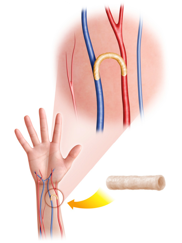 Revascularization